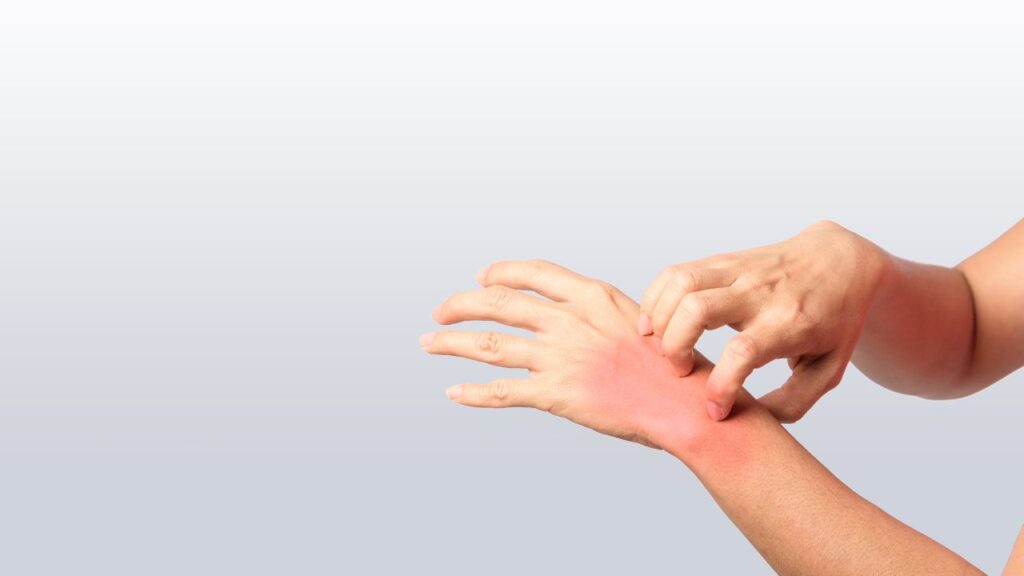 Skin Rashes or Peeling